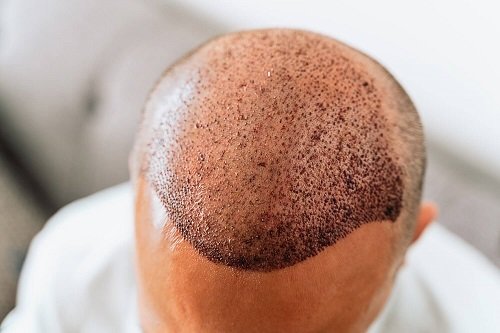 Discreet Hair Transplant Services in Riyadh